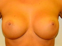 Case 17: Muscle splitting biplane breast augmentation, Mentor® anatomical implants 300 cc