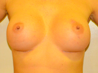 Case 23: Muscle splitting biplane breast augmentation, Mentor® anatomical implants 330 cc