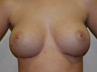 Case 26: Muscle splitting biplane breast augmentation, Mentor® anatomical implants 380 cc