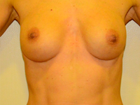 Case 59: Muscle splitting biplane breast augmentation, Mentor® anatomical implants 270 cc