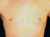 Male breast reduction surgery for gynecomastia