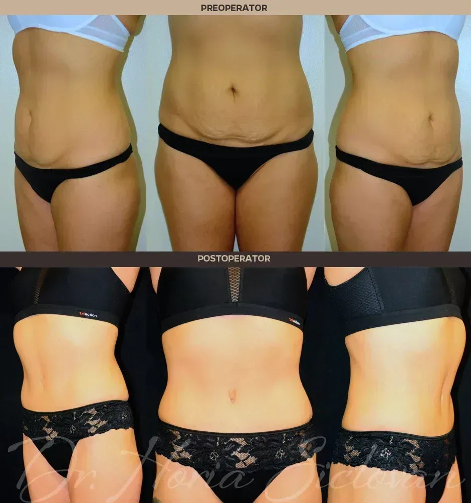 Caz 12: Abdominoplastie