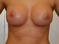 Caz 88: Augmentare mamara (tehnica muscle splitting biplane) si mamopexie interna, implanturi anatomice Mentor® 330 cm³