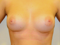 Case 73: Muscle splitting biplane breast augmentation, Mentor® anatomical implants 290 cc