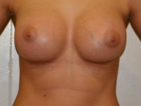 Case 88: Muscle splitting biplane breast augmentation with internal mastopexy, Mentor® anatomical implants 330 cc