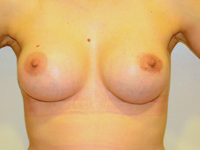 Case 93: Muscle splitting biplane breast augmentation with internal mastopexy, Mentor® anatomical implants 330 cc