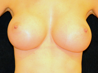 Case 98: Subfascial breast augmentation, Mentor® anatomical implants 330 cc and 380 cc