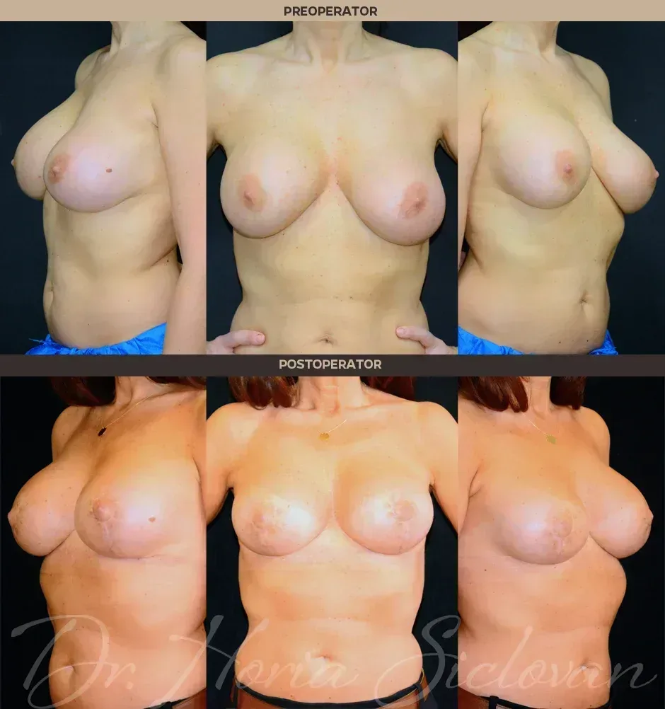 Preoperator: Augmentare mamara (muscle splitting biplane) implanturi anatomice Mentor® 390 cm³ (rezultat 8 ani postoperator) / Postoperator: Mamopexie cu augmentare mamara (muscle splitting biplane), implanturi rotunde Mentor® 340 cm³