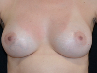 Case 113 - Subfascial breast augmentation, Mentor® anatomical implants 380 cc