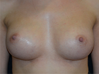 Case 114 - Subfascial breast augmentation, Mentor® anatomical implants 345 cc