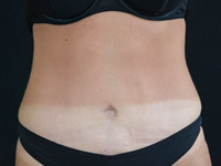 Case 13: Abdominoplasty