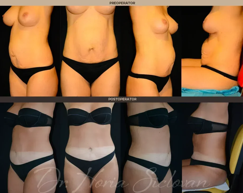 Caz 13 - Abdominoplastie