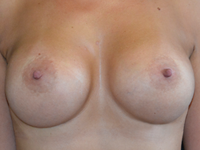 Caz 127 - Augmentare mamara (tehnica muscle splitting biplane) si mamopexie interna, implanturi anatomice Mentor 485 cm3