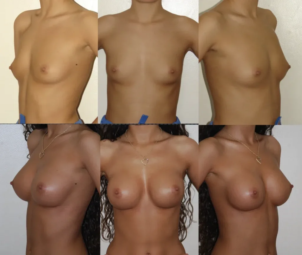 Augmentare mamară (tehnica muscle splitting biplane), implanturi anatomice Mentor 300 cm3
