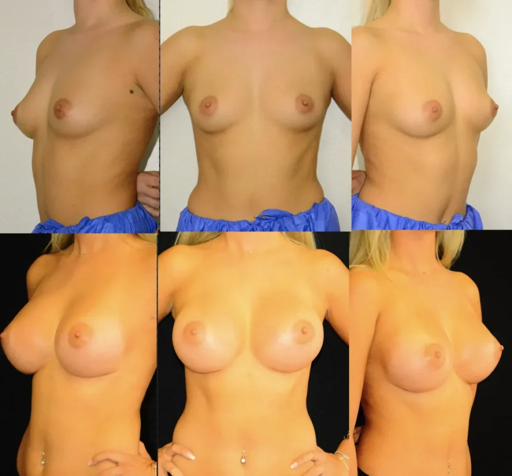 Augmentare mamară (tehnica subfasciala), implanturi anatomice Mentor 330 cm3