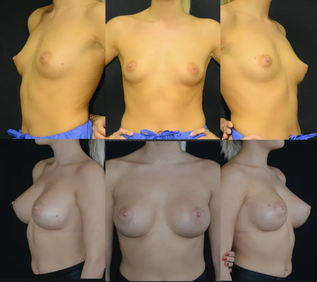 Augmentare mamară (tehnica subfasciala), implanturi anatomice Mentor 345 cm3