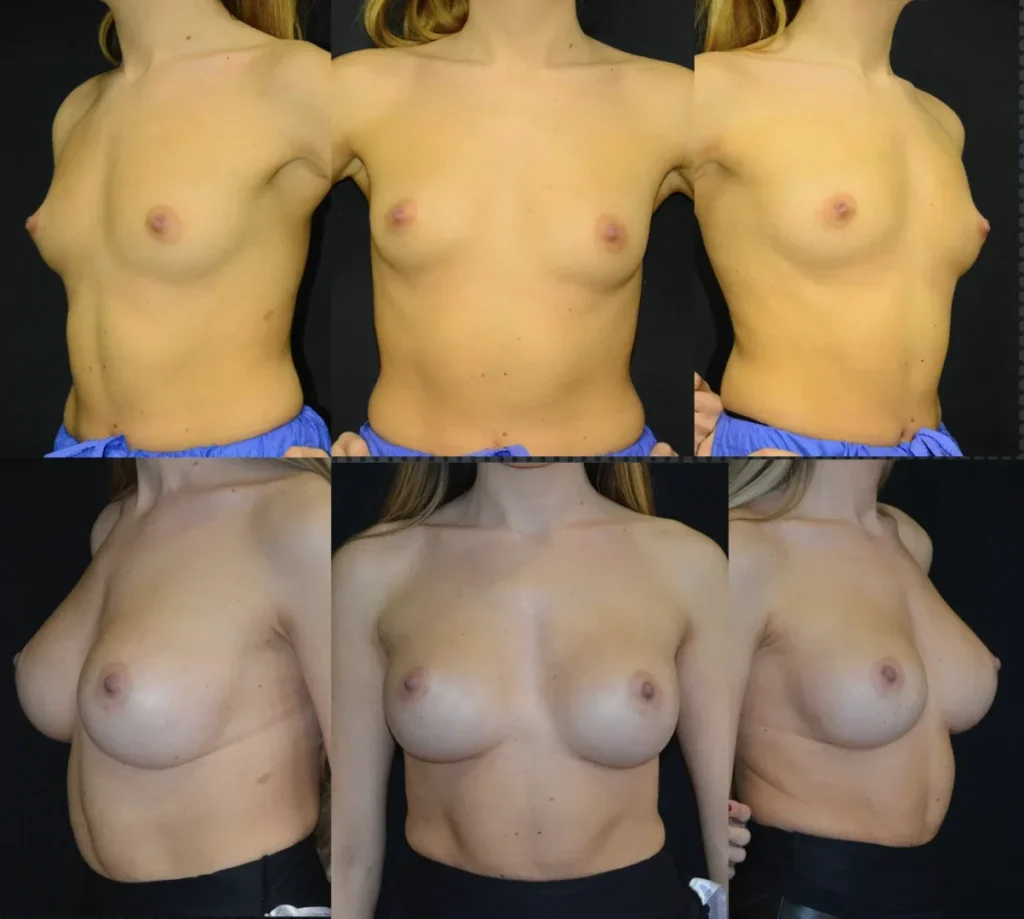 Augmentare mamară (tehnica subfasciala), implanturi anatomice Mentor 345 cm3