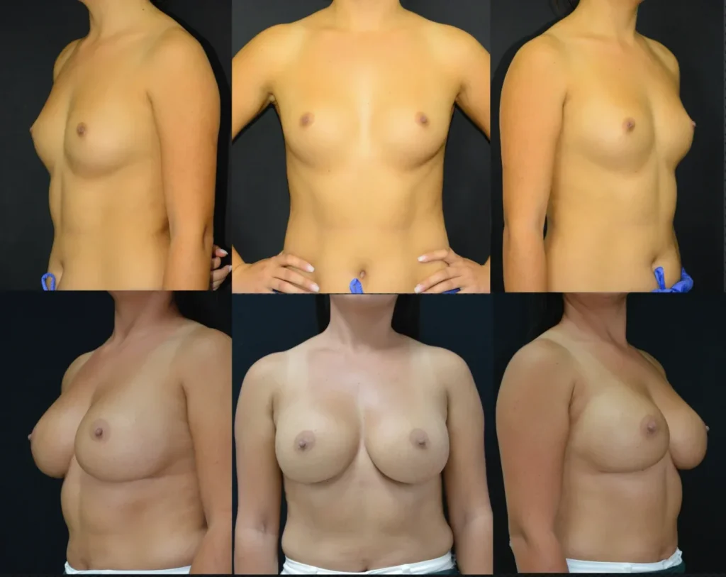Augmentare mamară (tehnica subfasciala), implanturi anatomice Mentor 290 cm3 (7 ani postoperator, 2 sarcini, 30 luni alaptare)