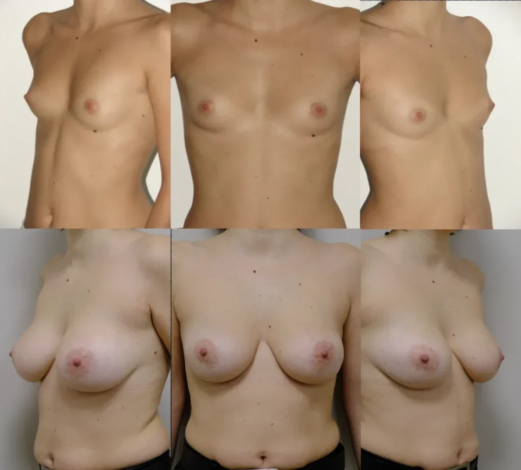 Augmentare mamară (tehnica subfasciala), implanturi anatomice Mentor 225 cm3 (10 ani postoperator, 2 sarcini și alaptare)