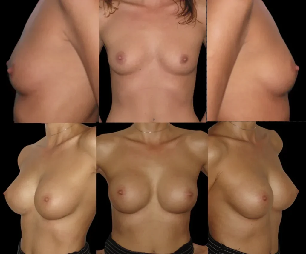 Augmentare mamară (tehnica subfasciala), implanturi anatomice Mentor 300 cm3