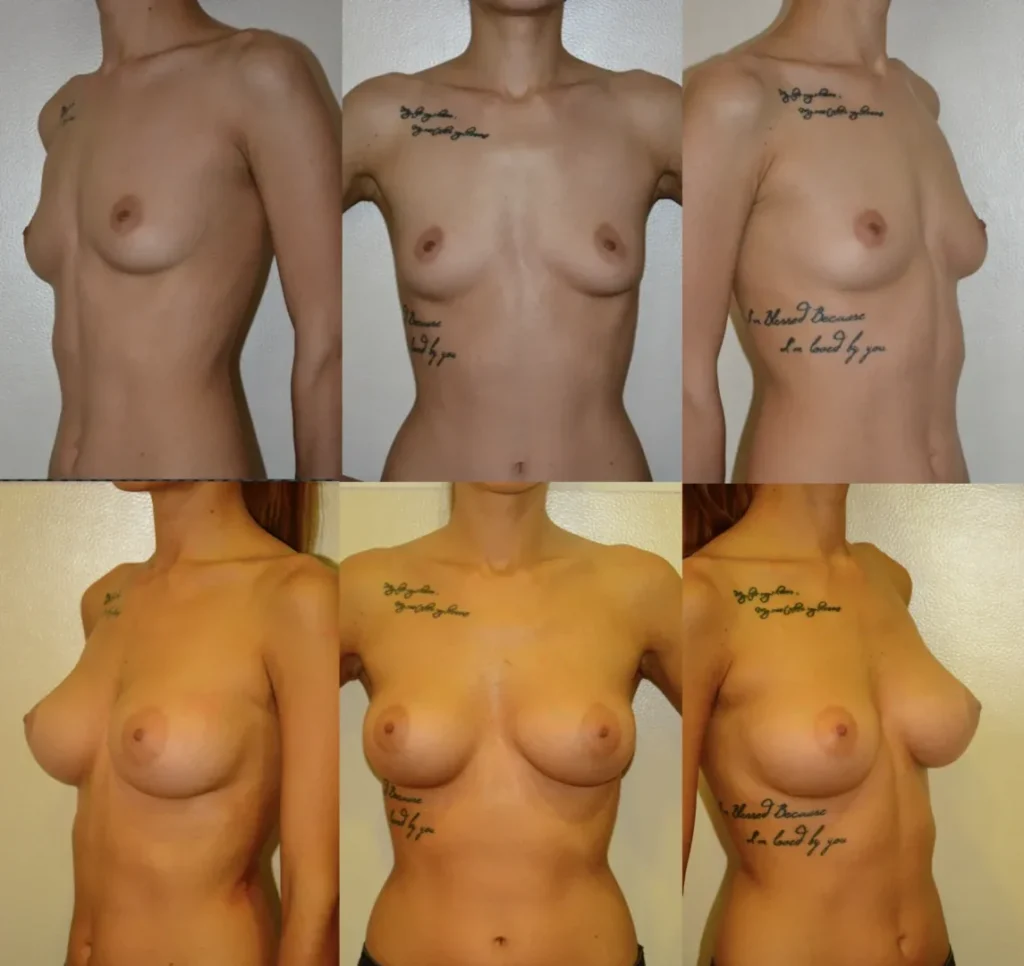 Augmentare mamară (tehnica muscle splitting biplane), implanturi anatomice Mentor 225 cm3