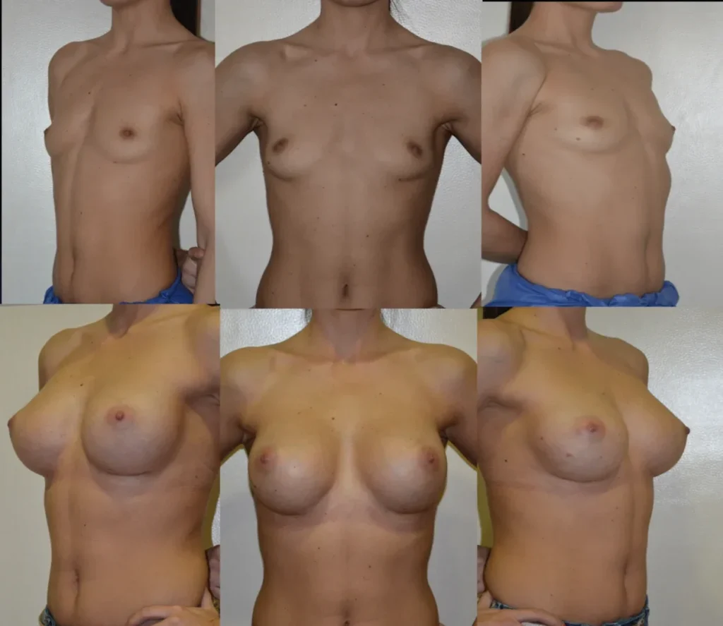 Augmentare mamară (tehnica muscle splitting biplane), implanturi anatomice Mentor 380 cm3
