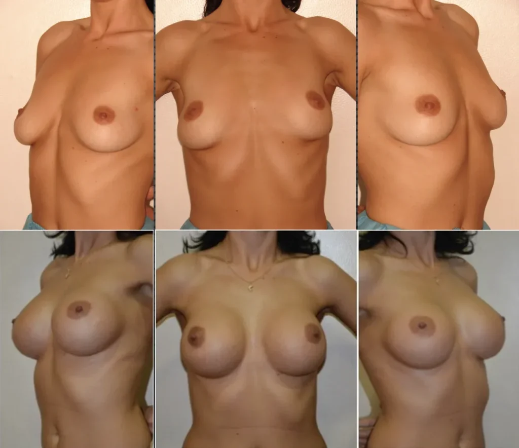 Augmentare mamară (tehnica muscle splitting biplane) cu mamopexie internă, implanturi anatomice Mentor 330 cm3