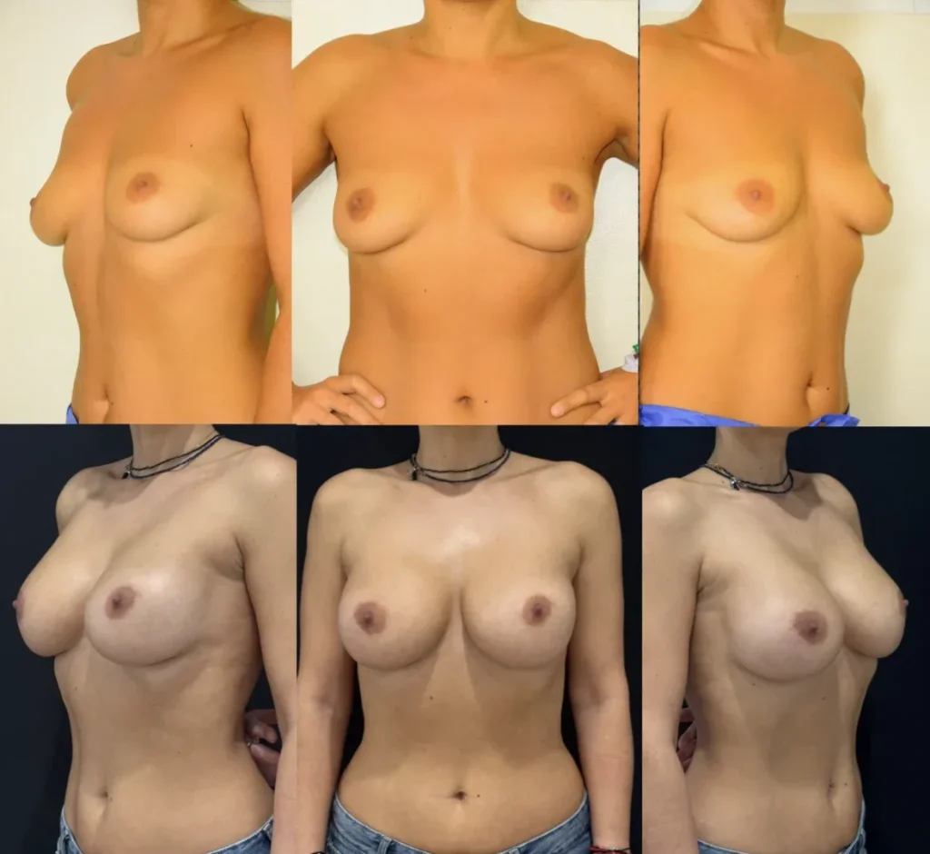 Augmentare mamară (tehnica muscle splitting biplane) cu mamopexie internă, implanturi anatomice Mentor 430 cm3