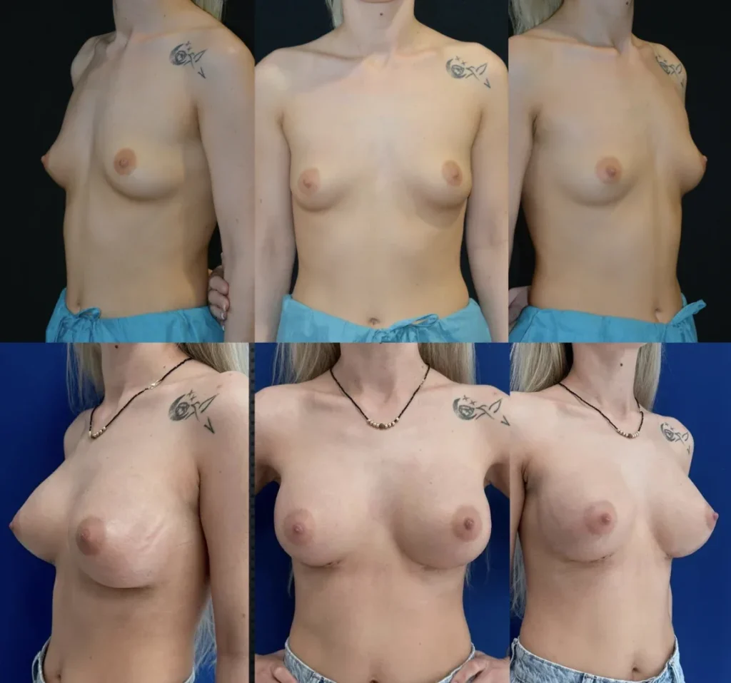 Augmentare mamară (tehnica muscle splitting biplane) cu mamopexie internă, implanturi anatomice Mentor 345 cm3