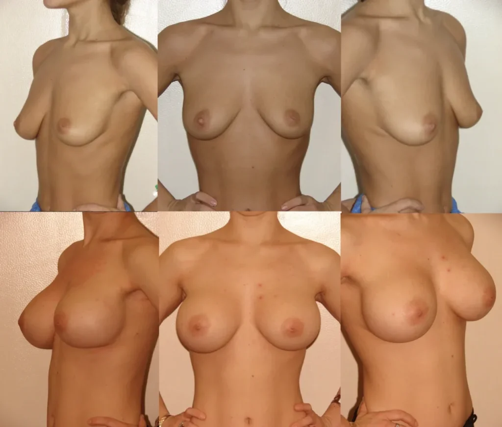 Augmentare mamară (tehnica muscle splitting biplane) cu mamopexie internă, implanturi anatomice Mentor 300 cm3