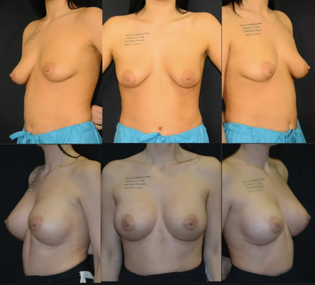 Augmentare mamară (tehnica muscle splitting biplane) cu mamopexie internă, implanturi anatomice Mentor 430 cm3