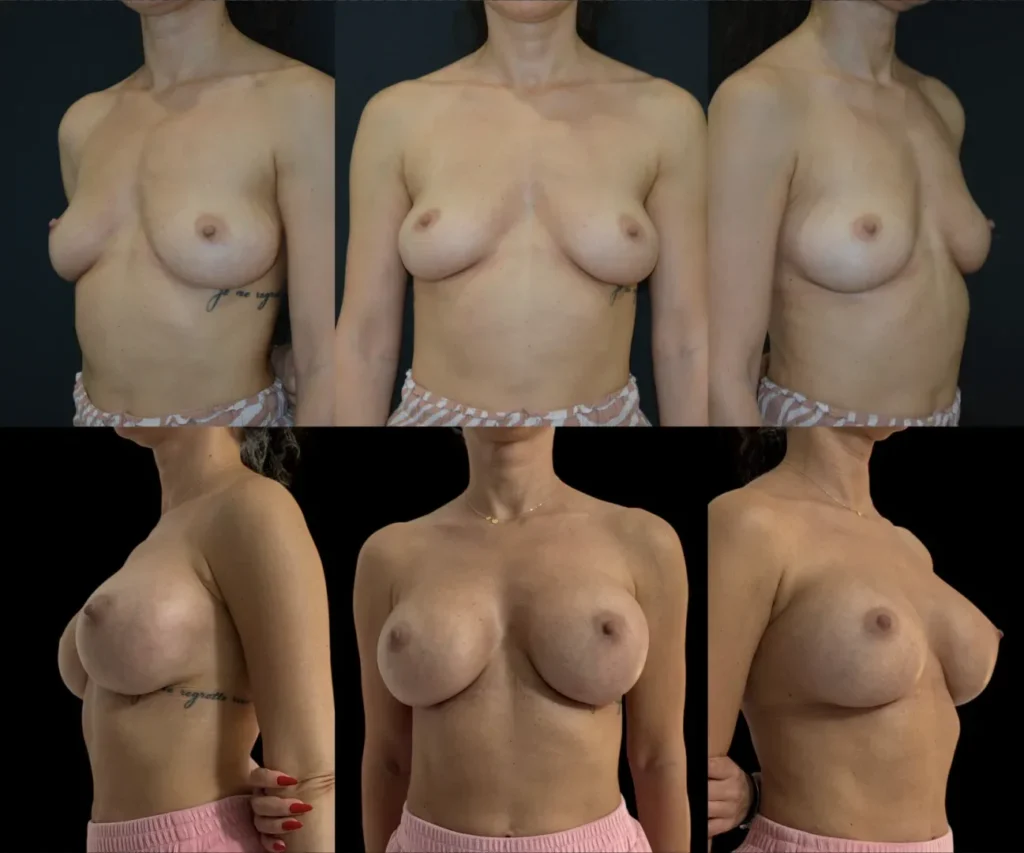 Augmentare mamară (tehnica muscle splitting biplane) cu mamopexie internă, implanturi rotunde Mentor 350 cm3