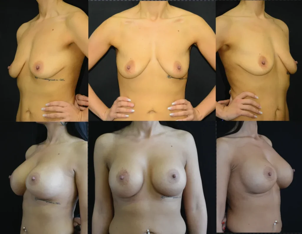 Augmentare mamară (tehnica muscle splitting biplane) cu mamopexie internă, implanturi anatomice Mentor 485 cm3
