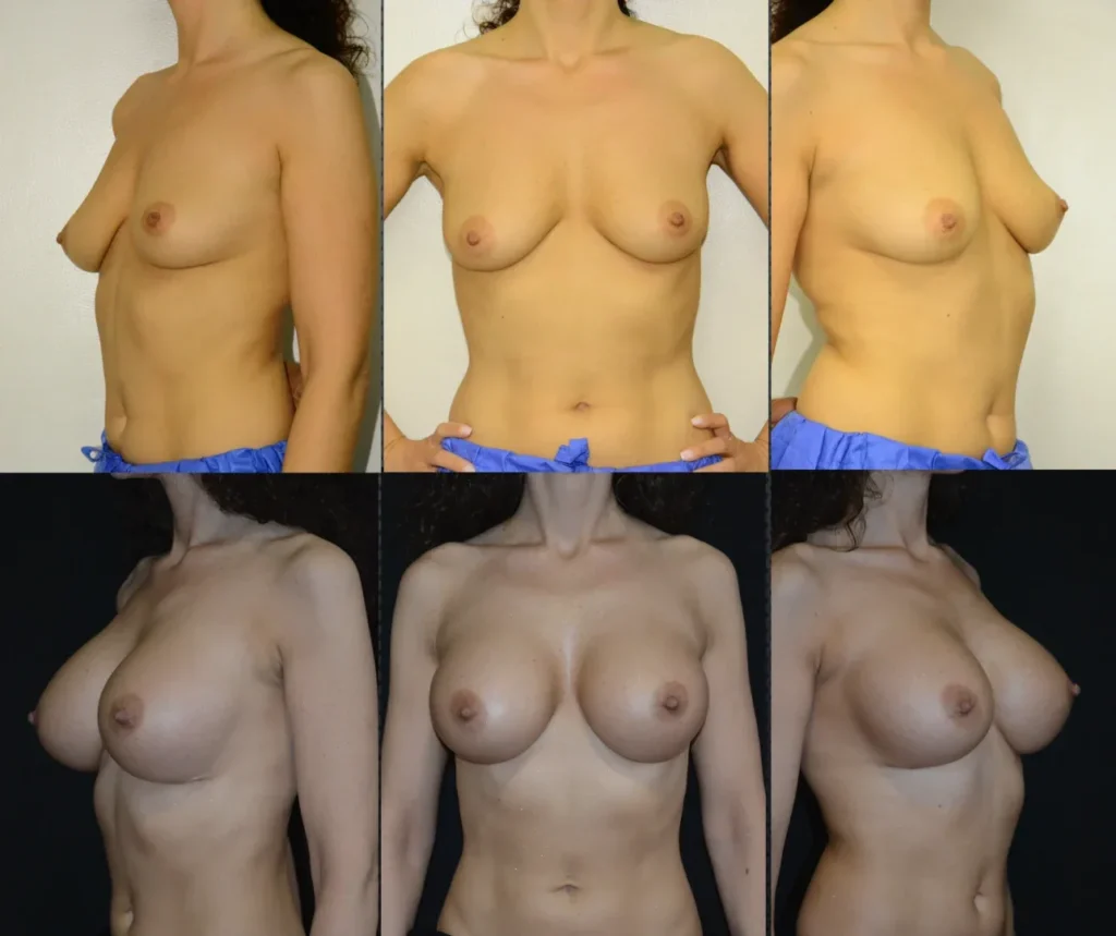 Augmentare mamară (tehnica muscle splitting biplane) cu mamopexie internă, implanturi anatomice Mentor 430 cm3