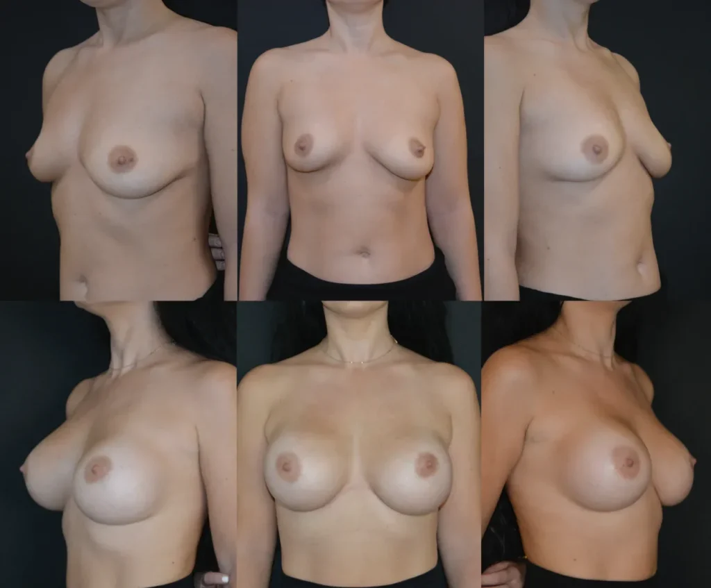 Augmentare mamară (tehnica muscle splitting biplane) cu mamopexie internă, implanturi rotunde Mentor 405 și 455 cm3