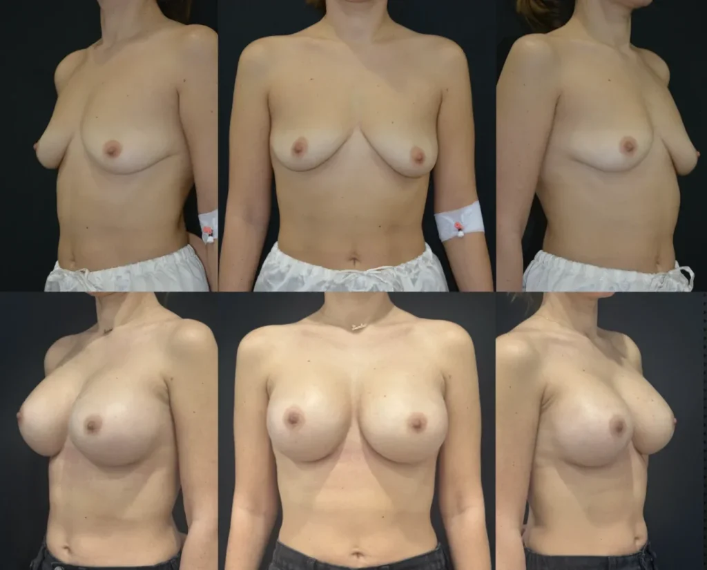 Augmentare mamară (tehnica muscle splitting biplane) cu mamopexie internă, implanturi anatomice Mentor 440 cm3