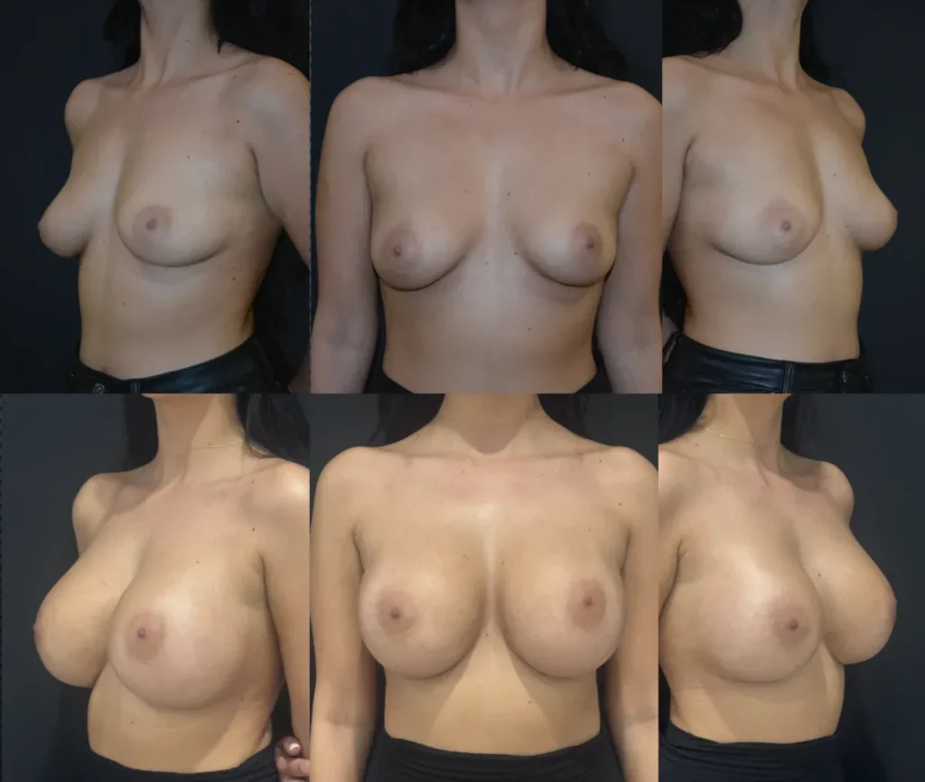 Augmentare mamară (tehnica muscle splitting biplane) cu mamopexie internă, implanturi rotunde Mentor 570 și 620 cm3