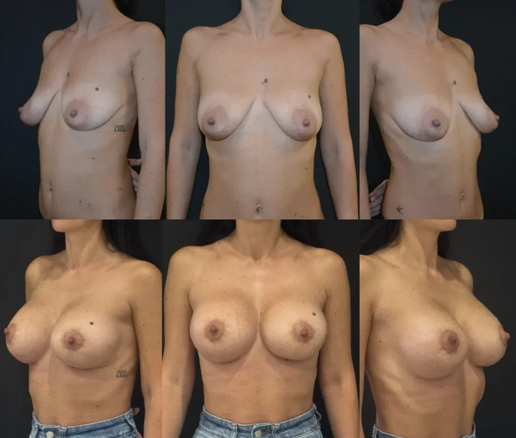Augmentare mamară (tehnica muscle splitting biplane) cu mamopexie internă și periareolară, implanturi anatomice Mentor 350 cm3